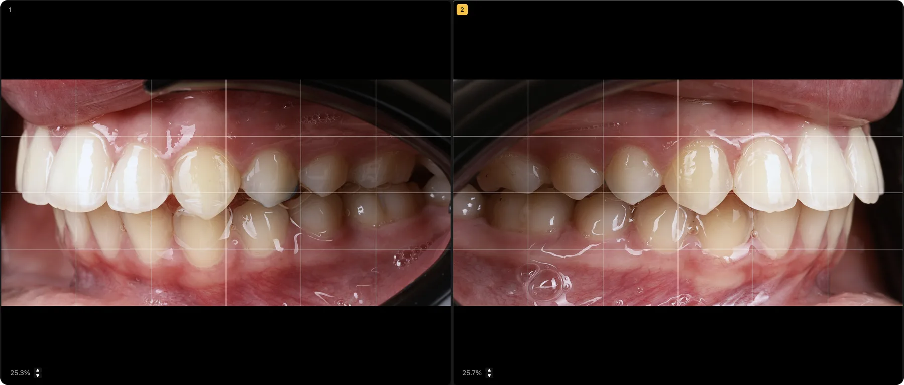 Deux vues d'occlusion latérale cadrées à l'identique dans le logiciel U-SHOOT, avec grille de composition — reproductibilité en photographie dentaire