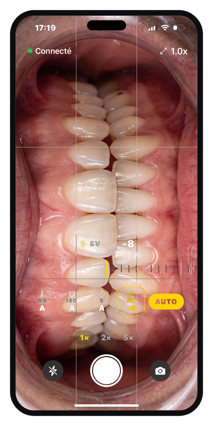 L'application U-SHOOT sur smartphone, capture d'un cas intra-oral en plein écran